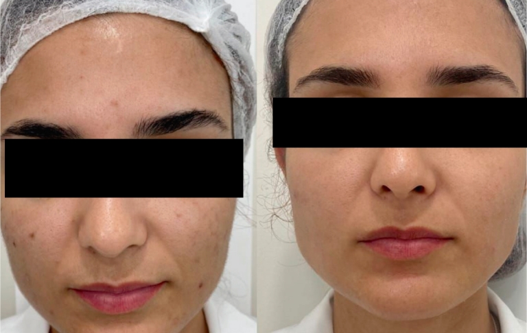 Resultados do Estudo Clínico Facial (Turma 601D)