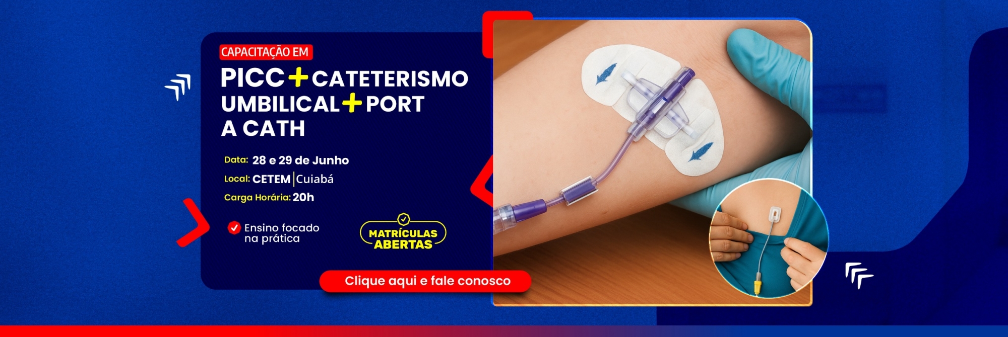 PICC + Cateterismo umbilical + Port a Cath
